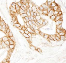 Detection of human beta Catenin by immunohistochemistry.