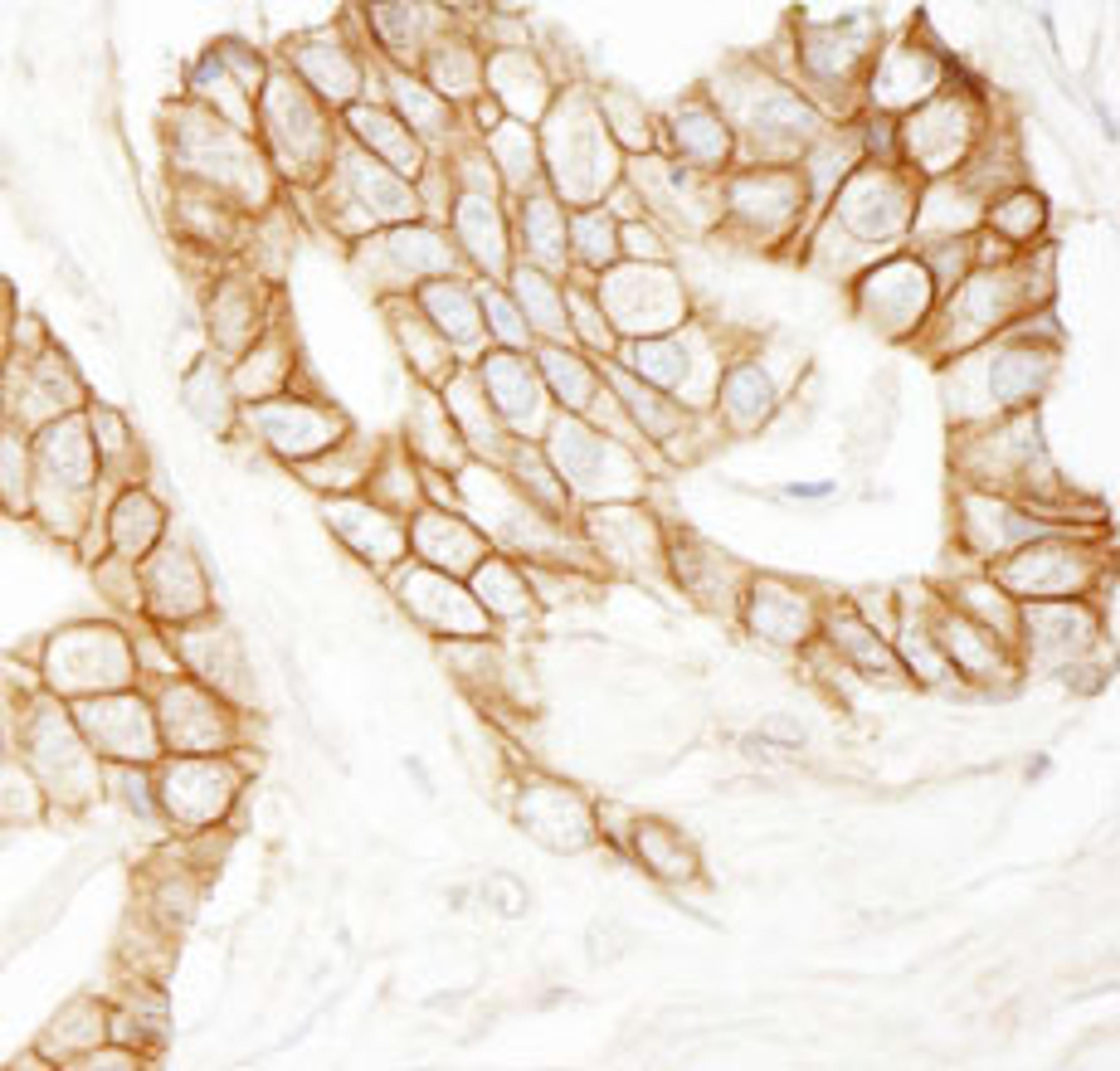 Detection of human beta Catenin by immunohistochemistry.