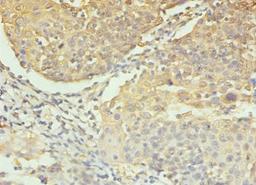 Immunohistochemistry of paraffin-embedded human colon cancer using CSB-PA05689A0Rb at dilution of 1:100