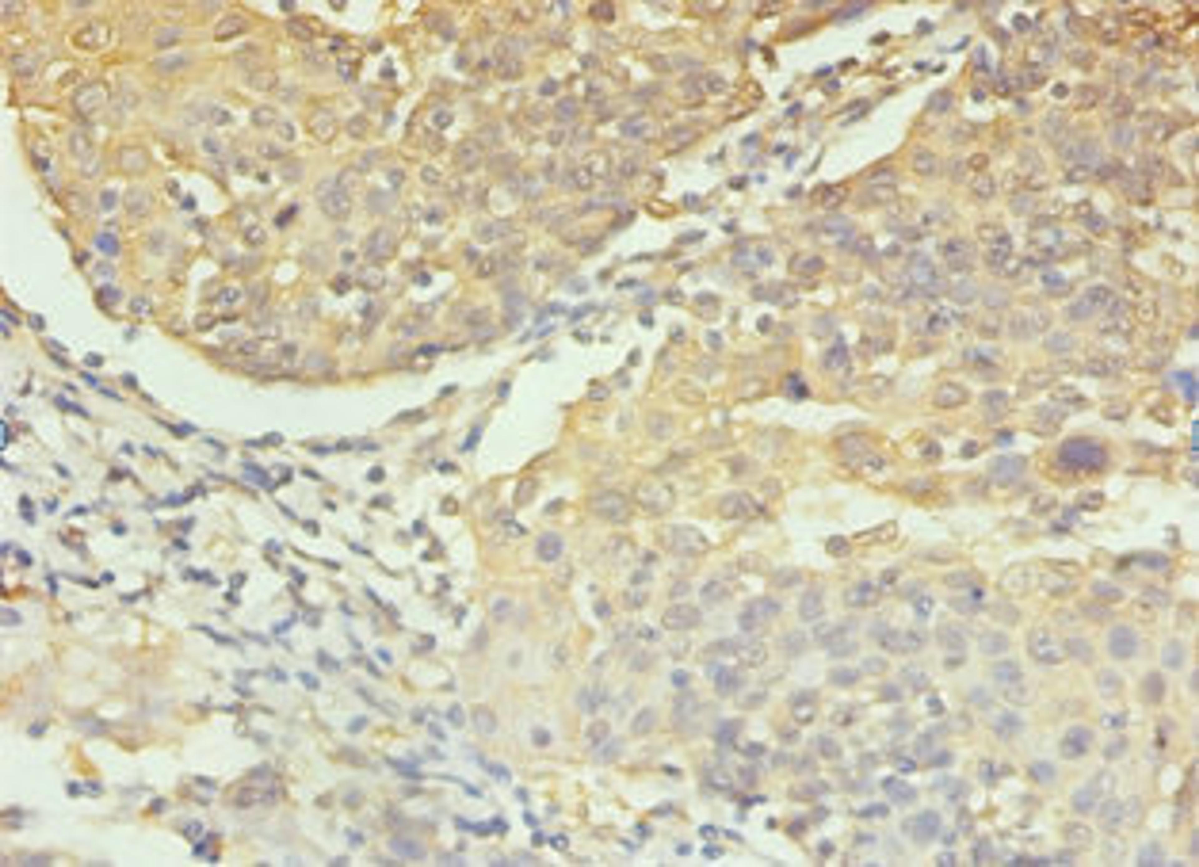 Immunohistochemistry of paraffin-embedded human colon cancer using CSB-PA05689A0Rb at dilution of 1:100