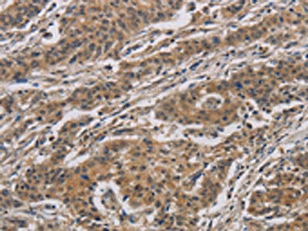 The image is immunohistochemistry of paraffin-embedded Human gastric cancer tissue using CSB-PA423088(CASP3 Antibody) at dilution 1/40. (Original magnification: X200)