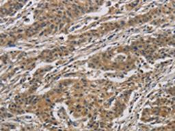 The image is immunohistochemistry of paraffin-embedded Human gastric cancer tissue using CSB-PA423088(CASP3 Antibody) at dilution 1/40. (Original magnification: X200)