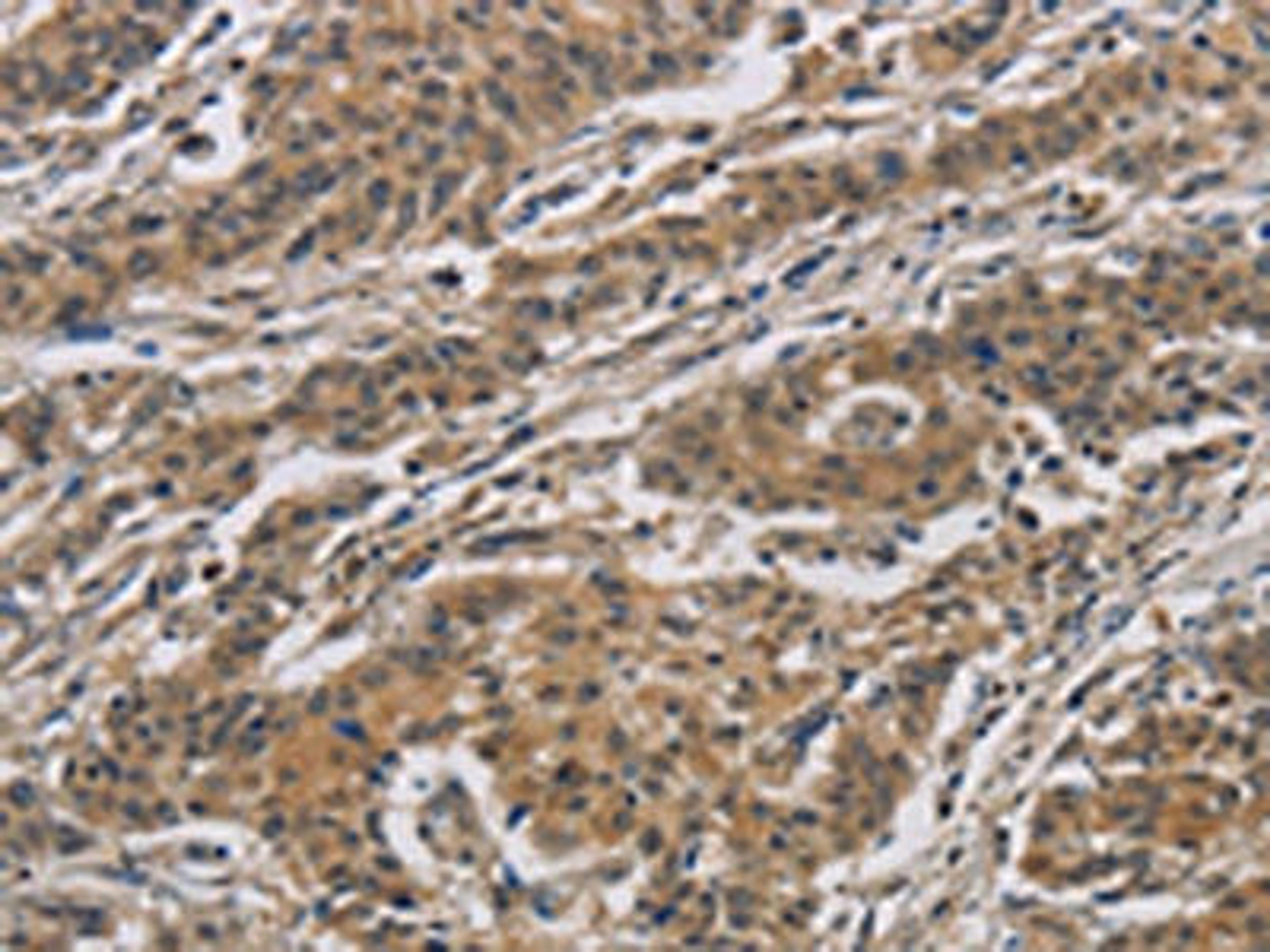 The image is immunohistochemistry of paraffin-embedded Human gastric cancer tissue using CSB-PA423088(CASP3 Antibody) at dilution 1/40. (Original magnification: X200)
