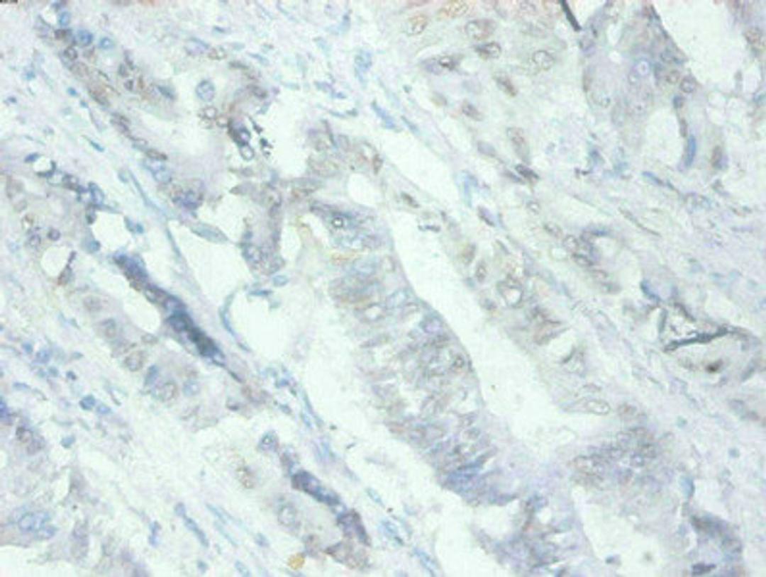 Immunohistochemical of paraffin-embedded human Colon cancer tissues using CSB-MA079741A0m at dilution of 1:200