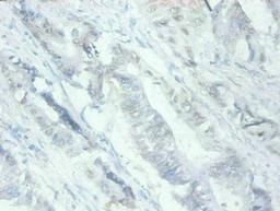 Immunohistochemical of paraffin-embedded human Colon cancer tissues using CSB-MA079741A0m at dilution of 1:200