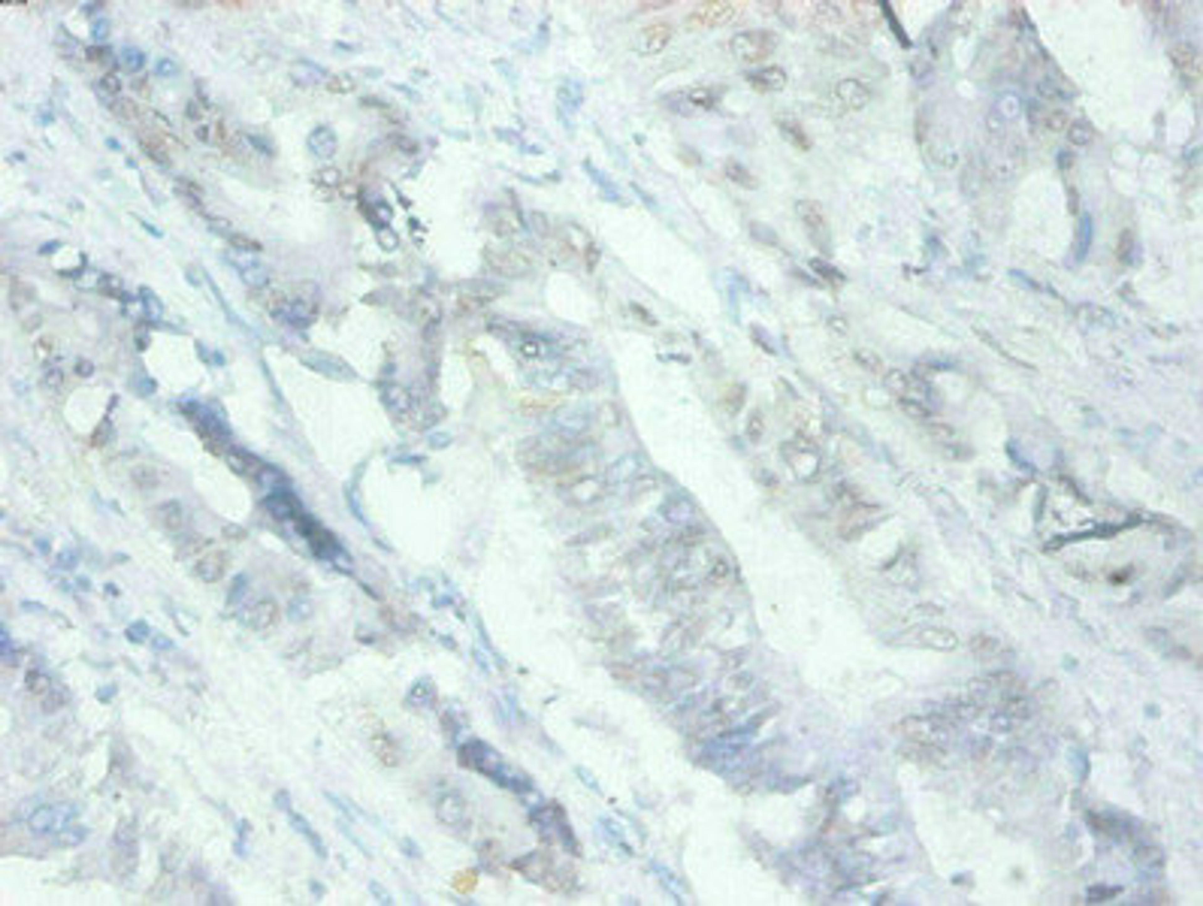 Immunohistochemical of paraffin-embedded human Colon cancer tissues using CSB-MA079741A0m at dilution of 1:200