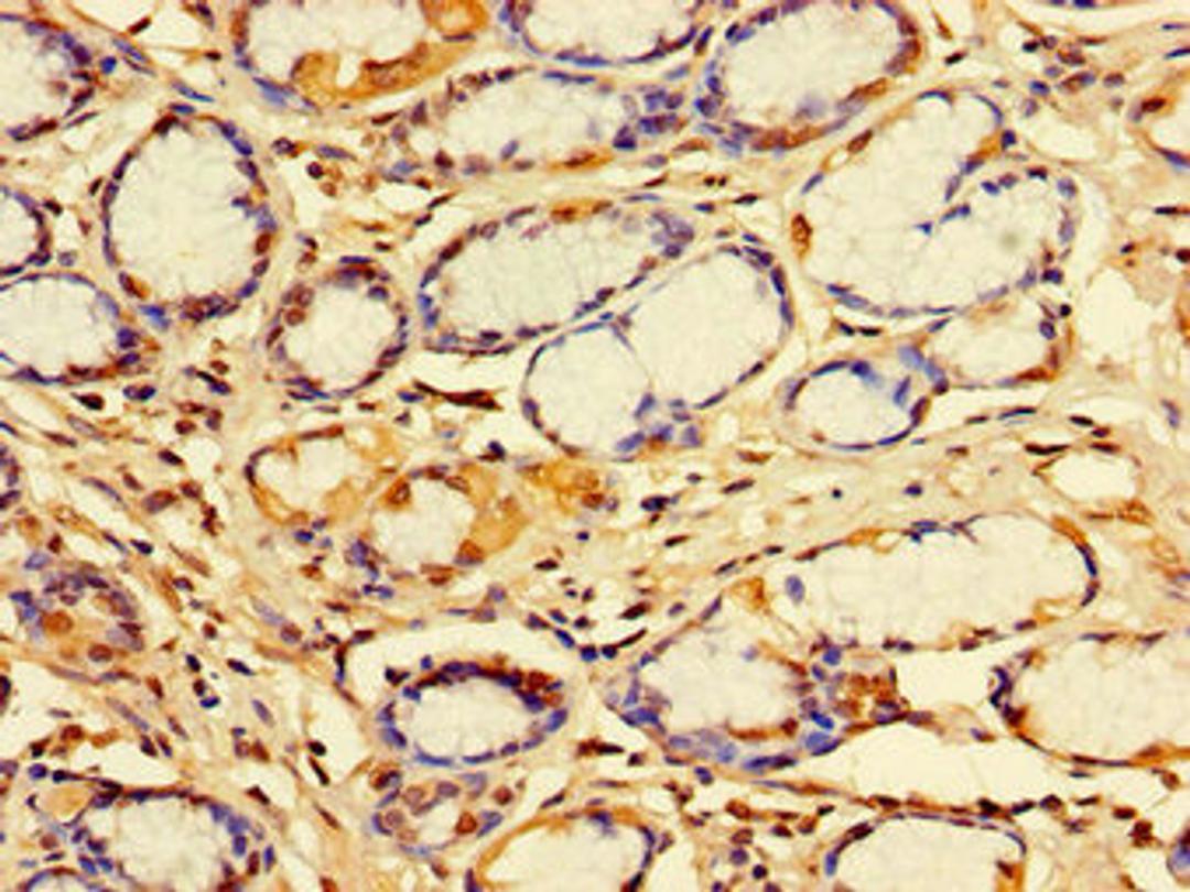 Immunohistochemistry of paraffin-embedded human gastric cancer using CSB-PA010988LA01HU at dilution of 1:100