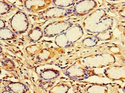 Immunohistochemistry of paraffin-embedded human gastric cancer using CSB-PA010988LA01HU at dilution of 1:100