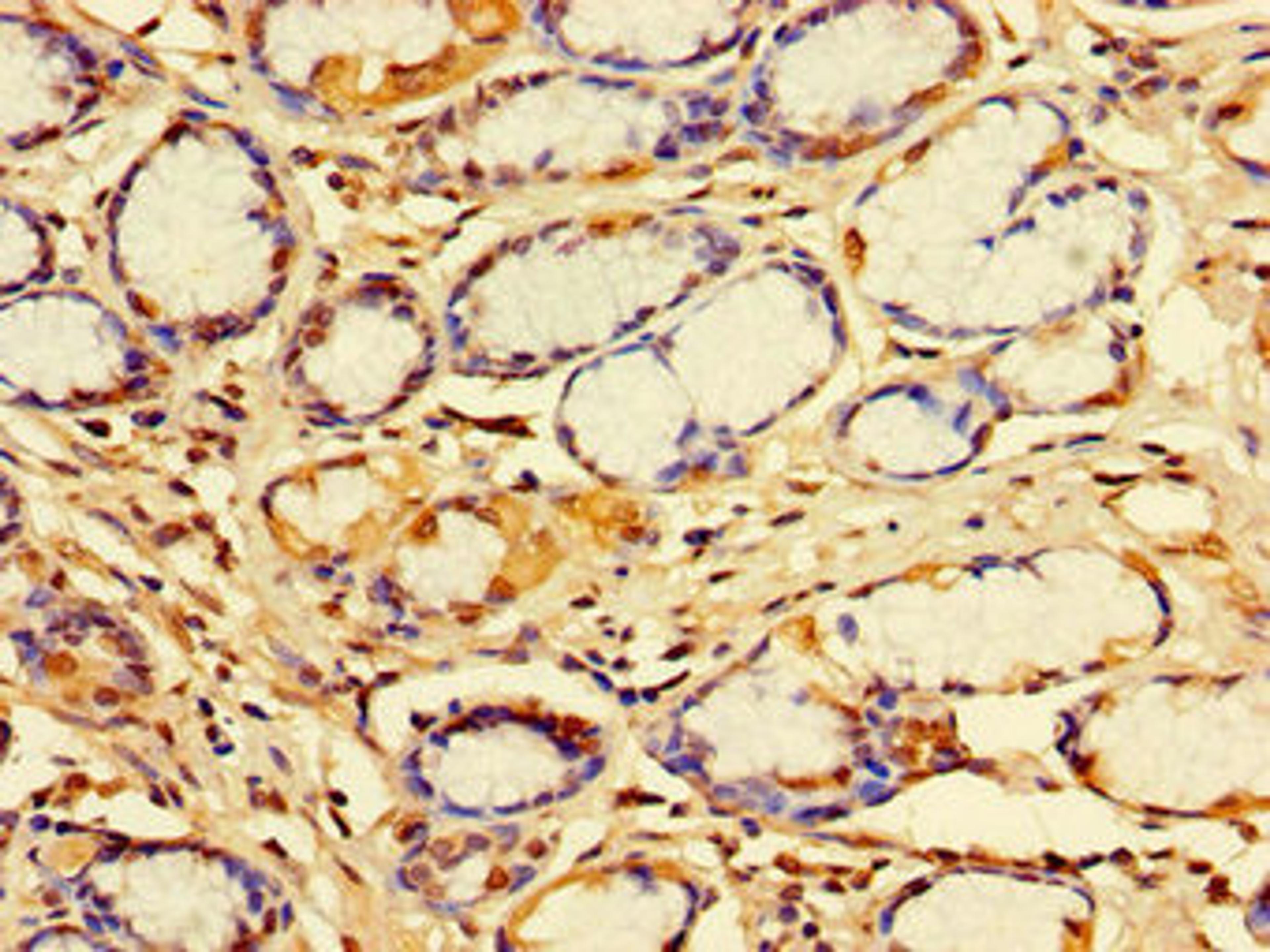 Immunohistochemistry of paraffin-embedded human gastric cancer using CSB-PA010988LA01HU at dilution of 1:100