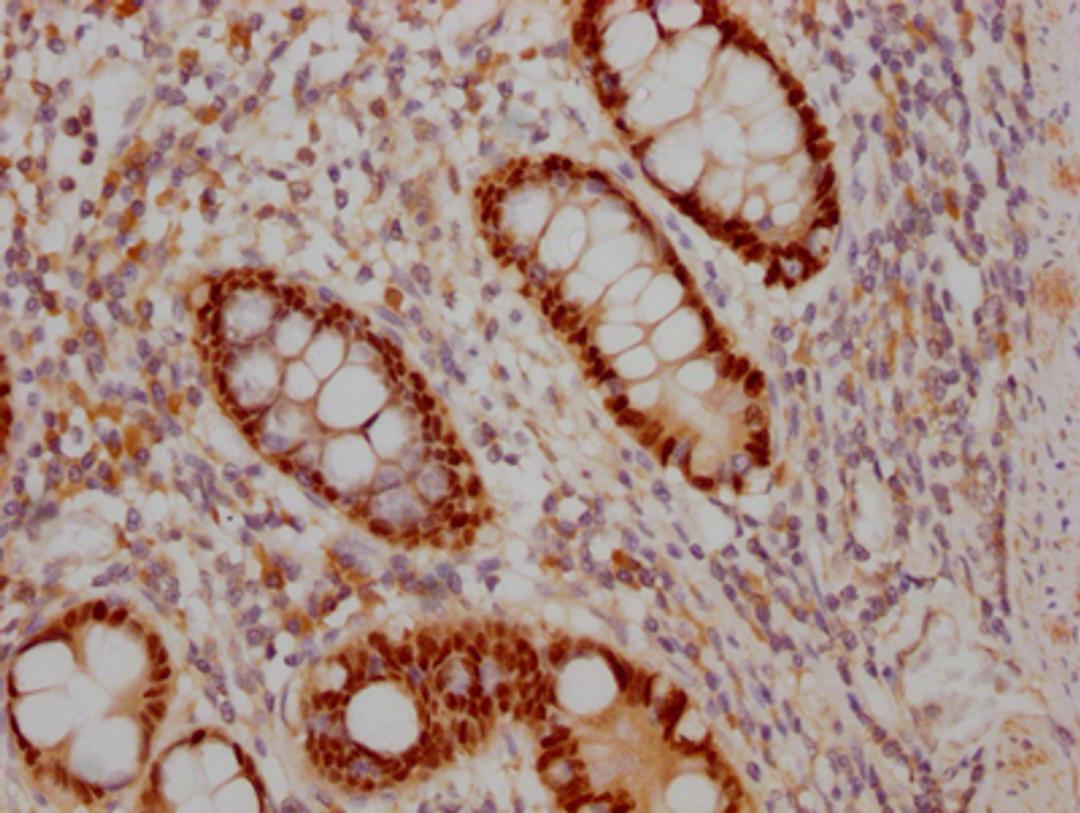 IHC image of CSB-RA202969A0HU diluted at 1:100 and staining in paraffin-embedded human colon cancer performed on a Leica BondTM system. After dewaxing and hydration, antigen retrieval was mediated by high pressure in a citrate buffer (pH 6.0). Section was blocked with 10% normal goat serum 30min at RT. Then primary antibody (1% BSA) was incubated at 4℃ overnight. The primary is detected by a Goat anti-rabbit IgG polymer labeled by HRP and visualized using 0.05% DAB.