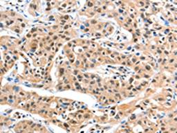 The image on the left is immunohistochemistry of paraffin-embedded Human liver cancer tissue using CSB-PA178606(DDX4 Antibody) at dilution 1/20, on the right is treated with fusion protein. (Original magnification: ×200)