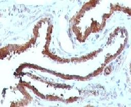 IHC testing of FFPE human prostate carcinoma and HSP27 antibody.