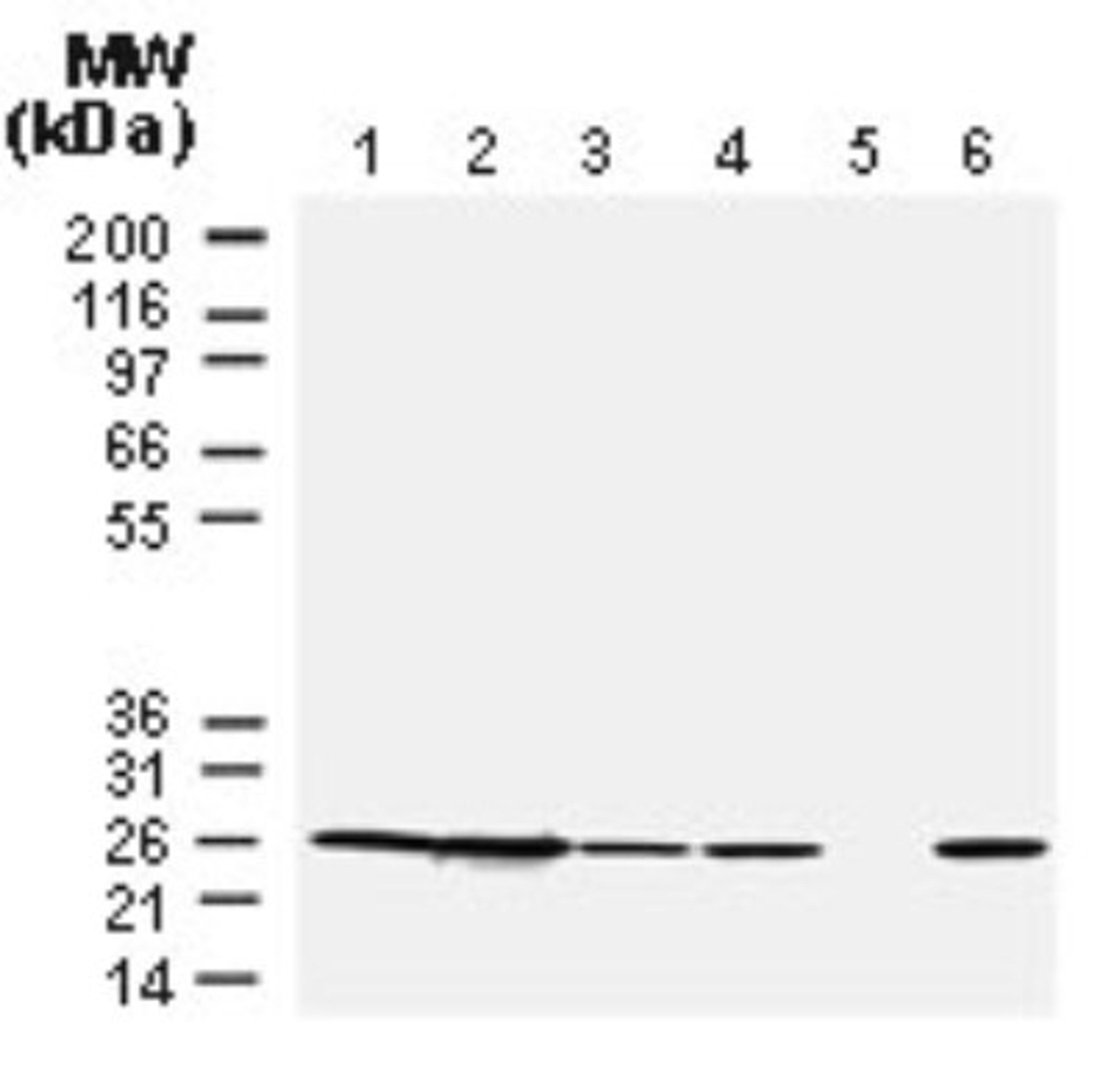 Western Blot: Bcl2 Antibody [NB100-56098] - Analysis of Bcl2 using this antibody at 1:2000, 20 ug/protein was loaded per lane. Lane 1. Human Jurkat T cells. Lane 2. Human RS11 lymphoma cells. Lanes 3-6. Human breast cancer cases. Patient sample in lane 5 lacked detectible Bcl-2 expression.