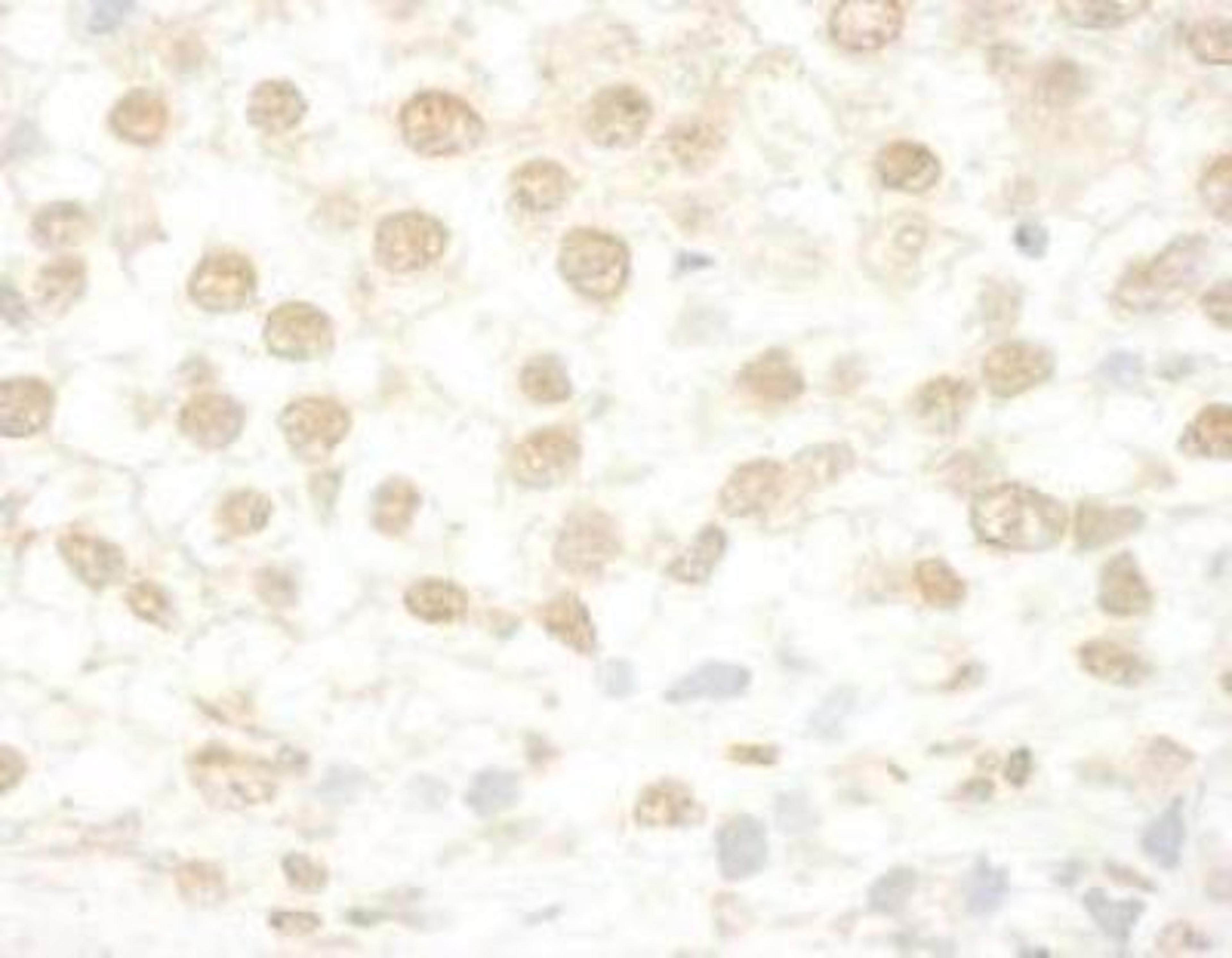 Immunohistochemistry-Paraffin: MLLT1 Antibody [NBP1-26653] - Section of human testicular seminoma.