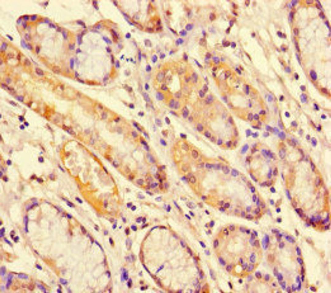 Immunohistochemistry of paraffin-embedded human gastric cancer using CSB-PA022810HA01HU at dilution of 1:100