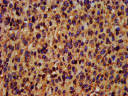 IHC image of CSB-PA892166LA01HU diluted at 1:400 and staining in paraffin-embedded human glioma performed on a Leica BondTM system. After dewaxing and hydration, antigen retrieval was mediated by high pressure in a citrate buffer (pH 6.0). Section was blocked with 10% normal goat serum 30min at RT. Then primary antibody (1% BSA) was incubated at 4°C overnight. The primary is detected by a biotinylated secondary antibody and visualized using an HRP conjugated SP system.