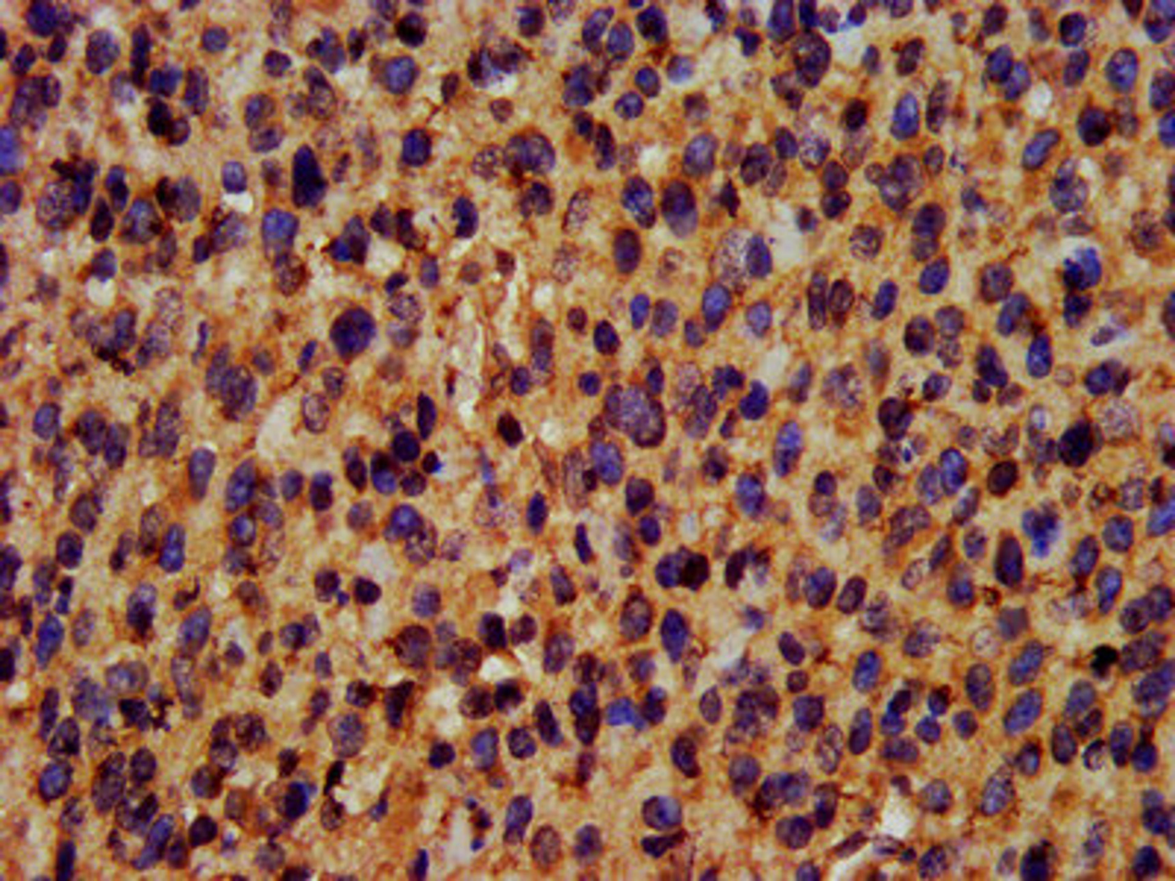 IHC image of CSB-PA892166LA01HU diluted at 1:400 and staining in paraffin-embedded human glioma performed on a Leica BondTM system. After dewaxing and hydration, antigen retrieval was mediated by high pressure in a citrate buffer (pH 6.0). Section was blocked with 10% normal goat serum 30min at RT. Then primary antibody (1% BSA) was incubated at 4°C overnight. The primary is detected by a biotinylated secondary antibody and visualized using an HRP conjugated SP system.