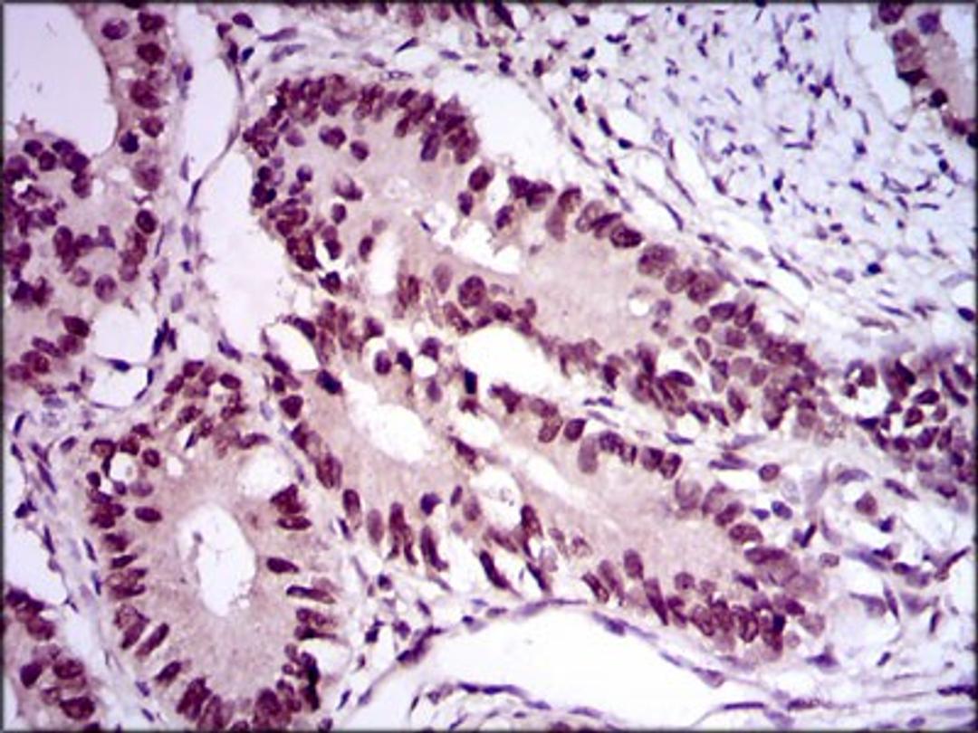 Immunohistochemistry: E2F-1 Antibody (8G9) [NBP2-37474] - Immunohistochemical analysis of paraffin-embedded rectum cancer tissues using E2F1 mouse mAb with DAB staining.