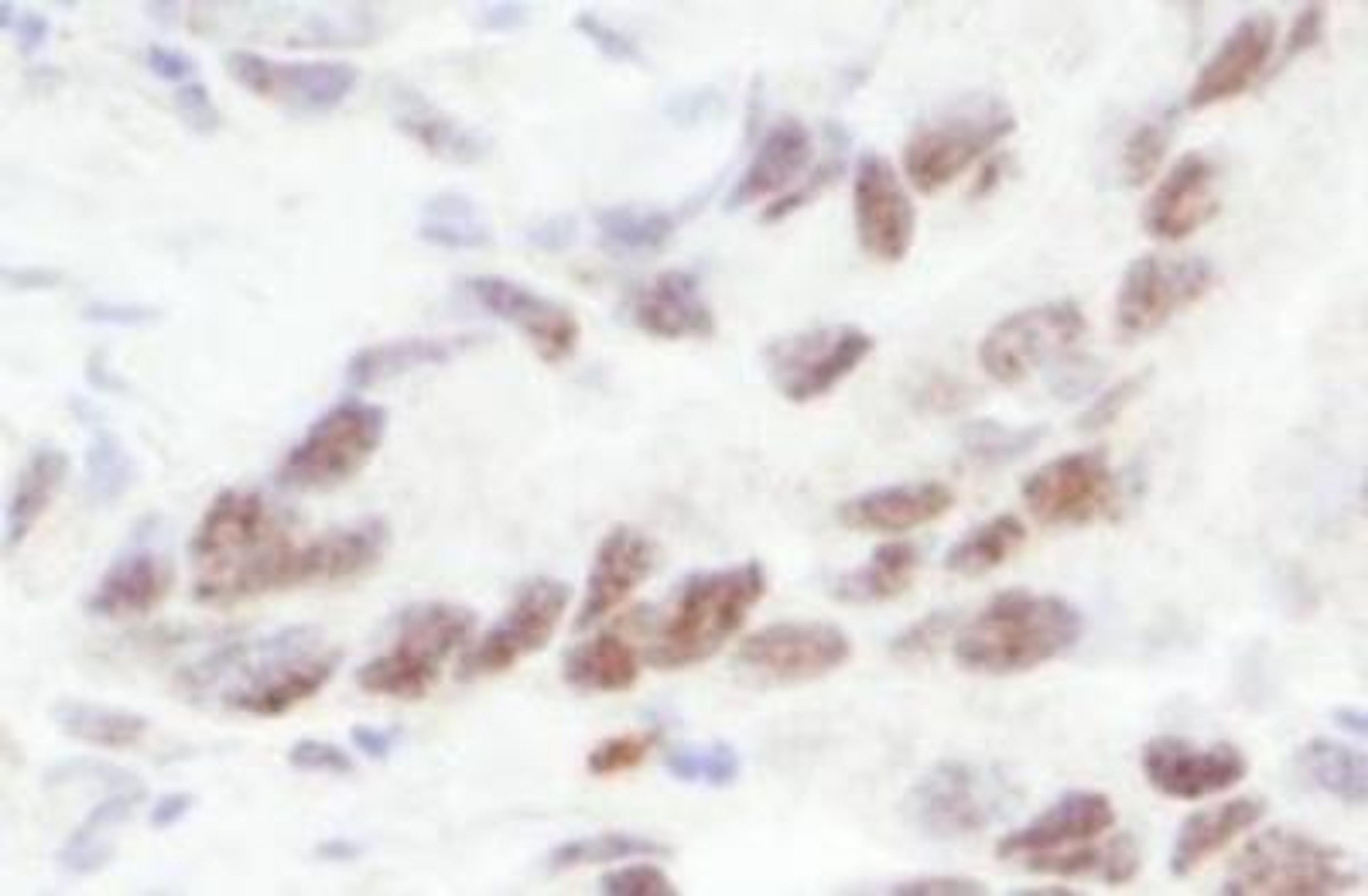 Immunohistochemistry-Paraffin: MTA1 Antibody [NB600-260] - Section of human stomach carcinoma.