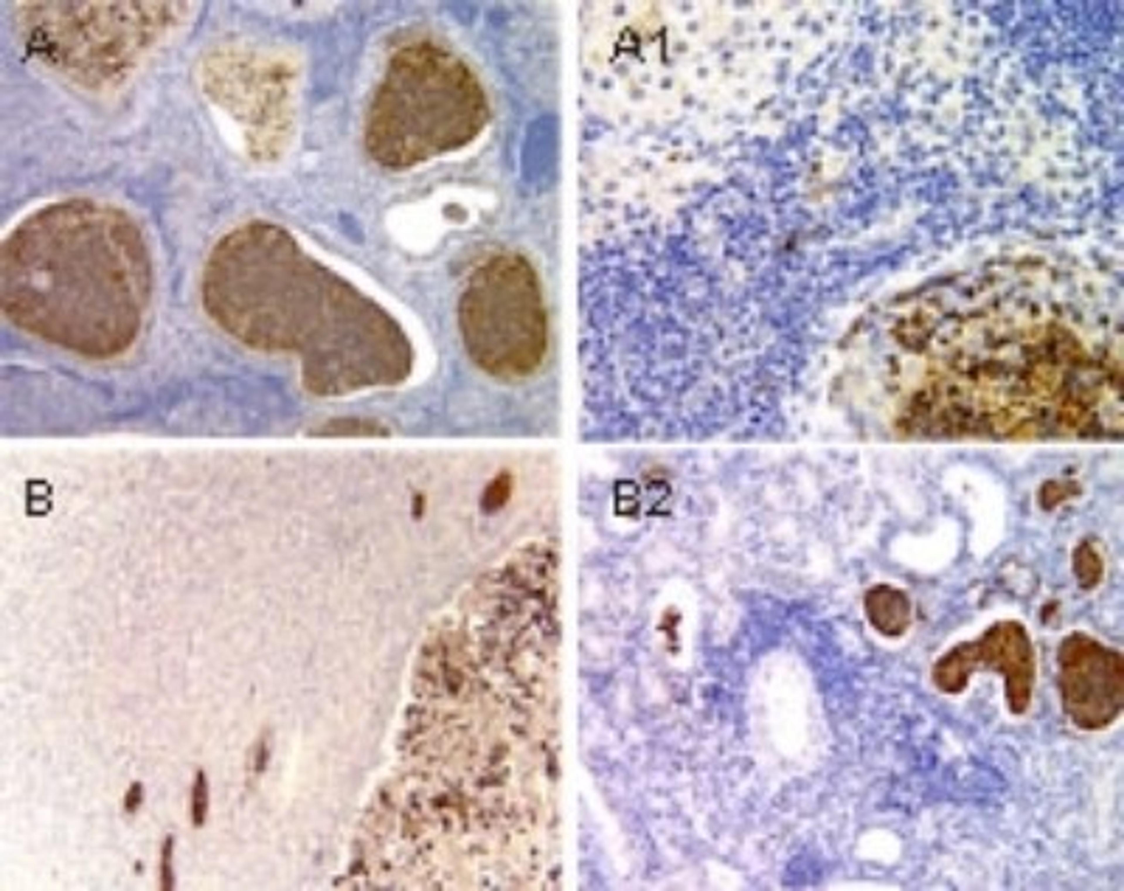 Immunohistochemistry: ASC2 Antibody [NB100-56076] - Immunhistochemical analysis of ASC2/POP1 expression in mouse using NB100-56076 at 1:2000. A, prostate tissue from a male mouse prostatitis. B, kidney from a mouse with pyelonephritis. A1 and B1, high magnification of A and B, respectively.