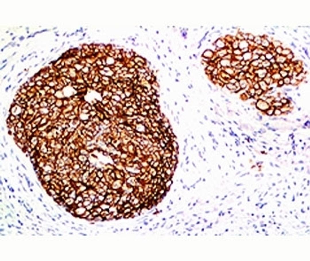 FFPE staining of human breast carcinoma with HER-2 antibody (ERB2/776).