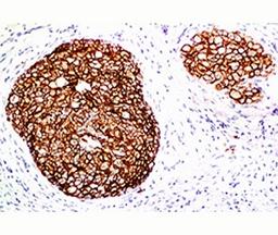 FFPE staining of human breast carcinoma with HER-2 antibody (ERB2/776).