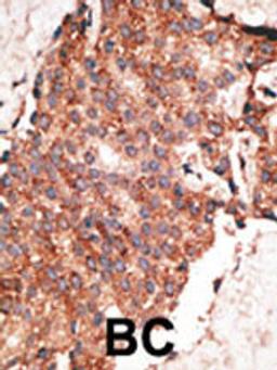 Formalin-fixed and paraffin-embedded human cancer tissue reacted with the primary antibody, which was peroxidase-conjugated to the secondary antibody, followed by AEC staining. BC = breast carcinoma; HC = hepatocarcinoma.