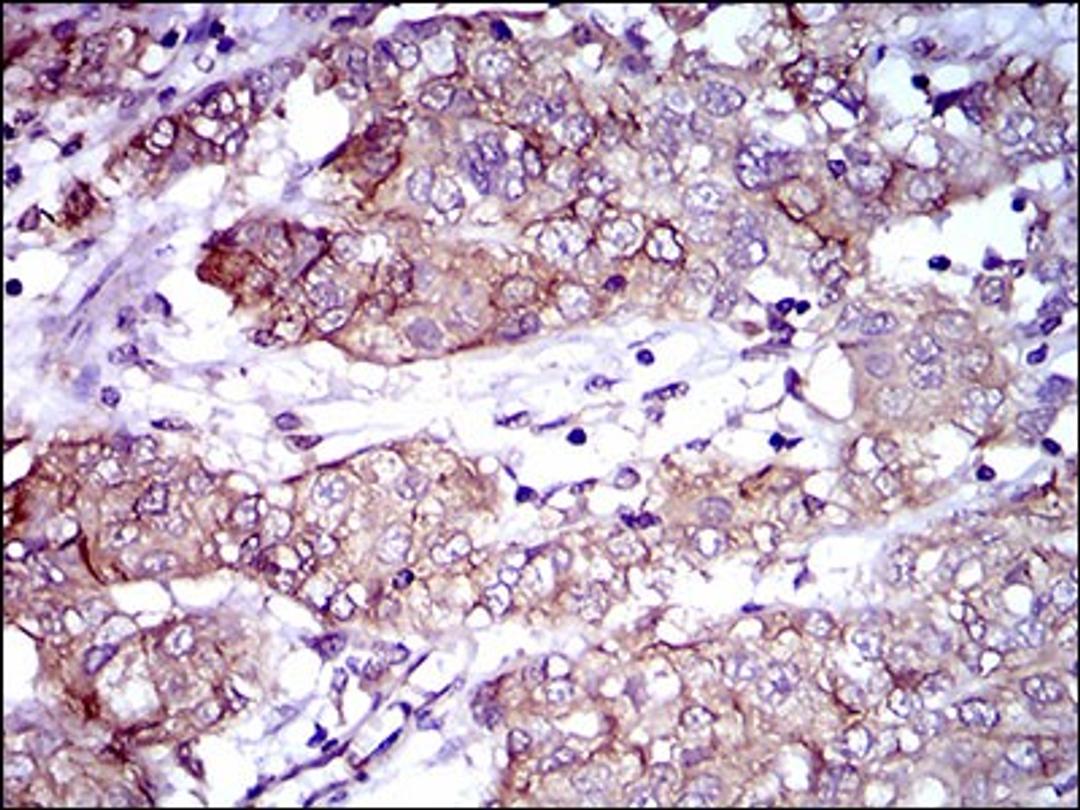 Immunohistochemistry: ALCAM/CD166 Antibody (8E12C7) [NBP2-37358] - Immunohistochemical analysis of paraffin-embedded bladder cancer tissues using ALCAM mouse mAb with DAB staining.