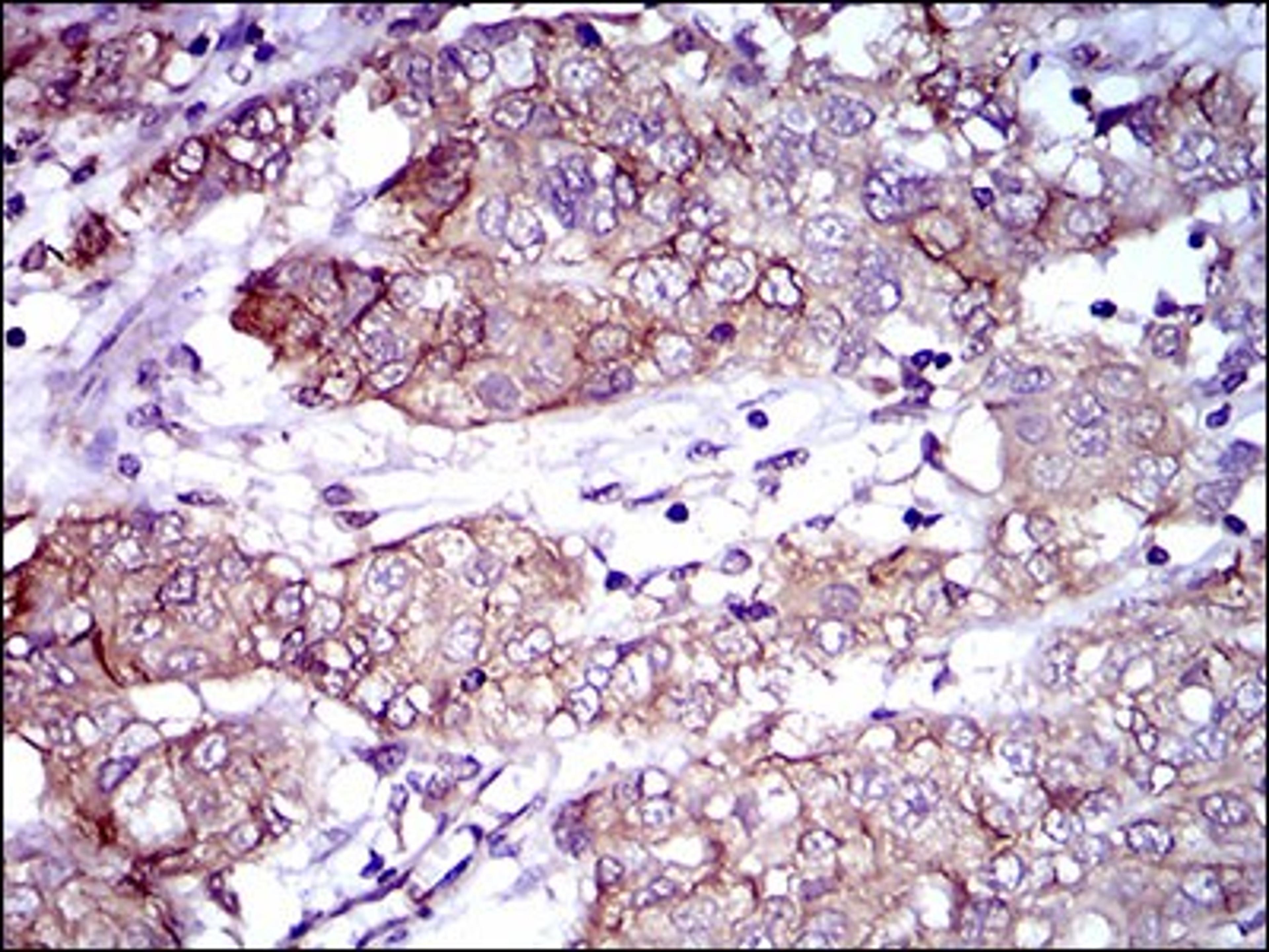 Immunohistochemistry: ALCAM/CD166 Antibody (8E12C7) [NBP2-37358] - Immunohistochemical analysis of paraffin-embedded bladder cancer tissues using ALCAM mouse mAb with DAB staining.