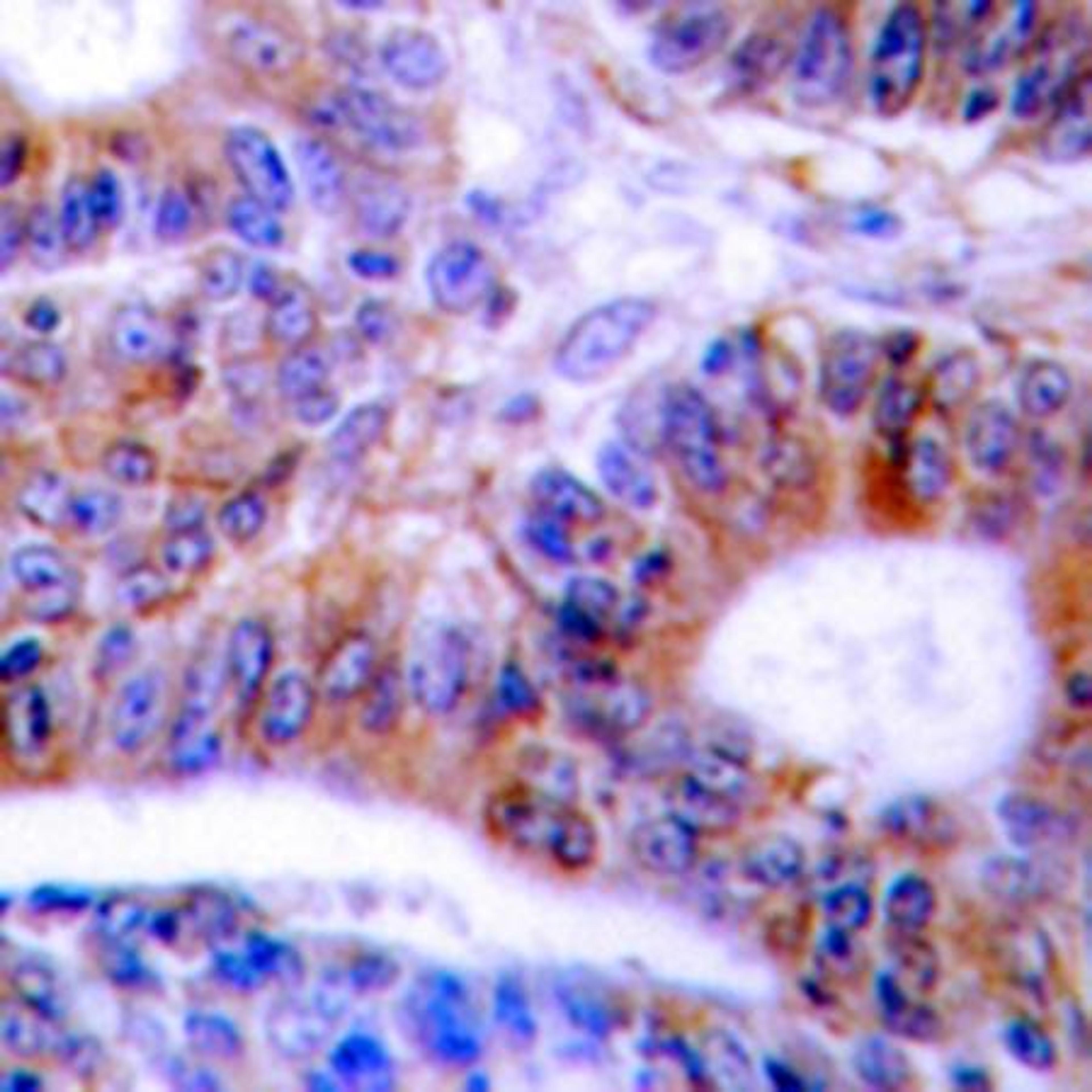 Immunohistochemical analysis of formalin-fixed and paraffin-embedded human colon cancer tissue using Cytokeratin 20 antibody