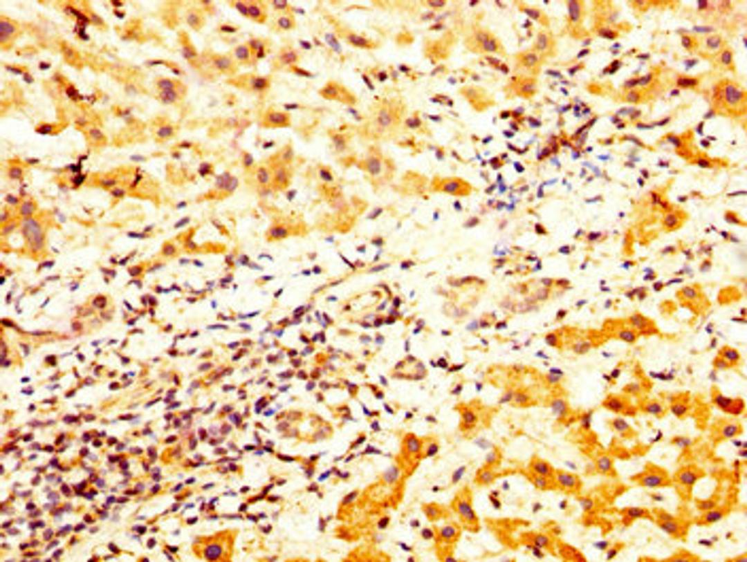 IHC image of CSB-PA023320LA01HU diluted at 1:800 and staining in paraffin-embedded human liver cancer performed on a Leica BondTM system. After dewaxing and hydration, antigen retrieval was mediated by high pressure in a citrate buffer (pH 6.0). Section was blocked with 10% normal goat serum 30min at RT. Then primary antibody (1% BSA) was incubated at 4&deg;C overnight. The primary is detected by a biotinylated secondary antibody and visualized using an HRP conjugated SP system.