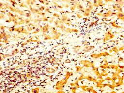 IHC image of CSB-PA023320LA01HU diluted at 1:800 and staining in paraffin-embedded human liver cancer performed on a Leica BondTM system. After dewaxing and hydration, antigen retrieval was mediated by high pressure in a citrate buffer (pH 6.0). Section was blocked with 10% normal goat serum 30min at RT. Then primary antibody (1% BSA) was incubated at 4&deg;C overnight. The primary is detected by a biotinylated secondary antibody and visualized using an HRP conjugated SP system.