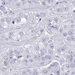 Immunohistochemistry: QDPR Antibody [NBP2-32408] - liver cancer