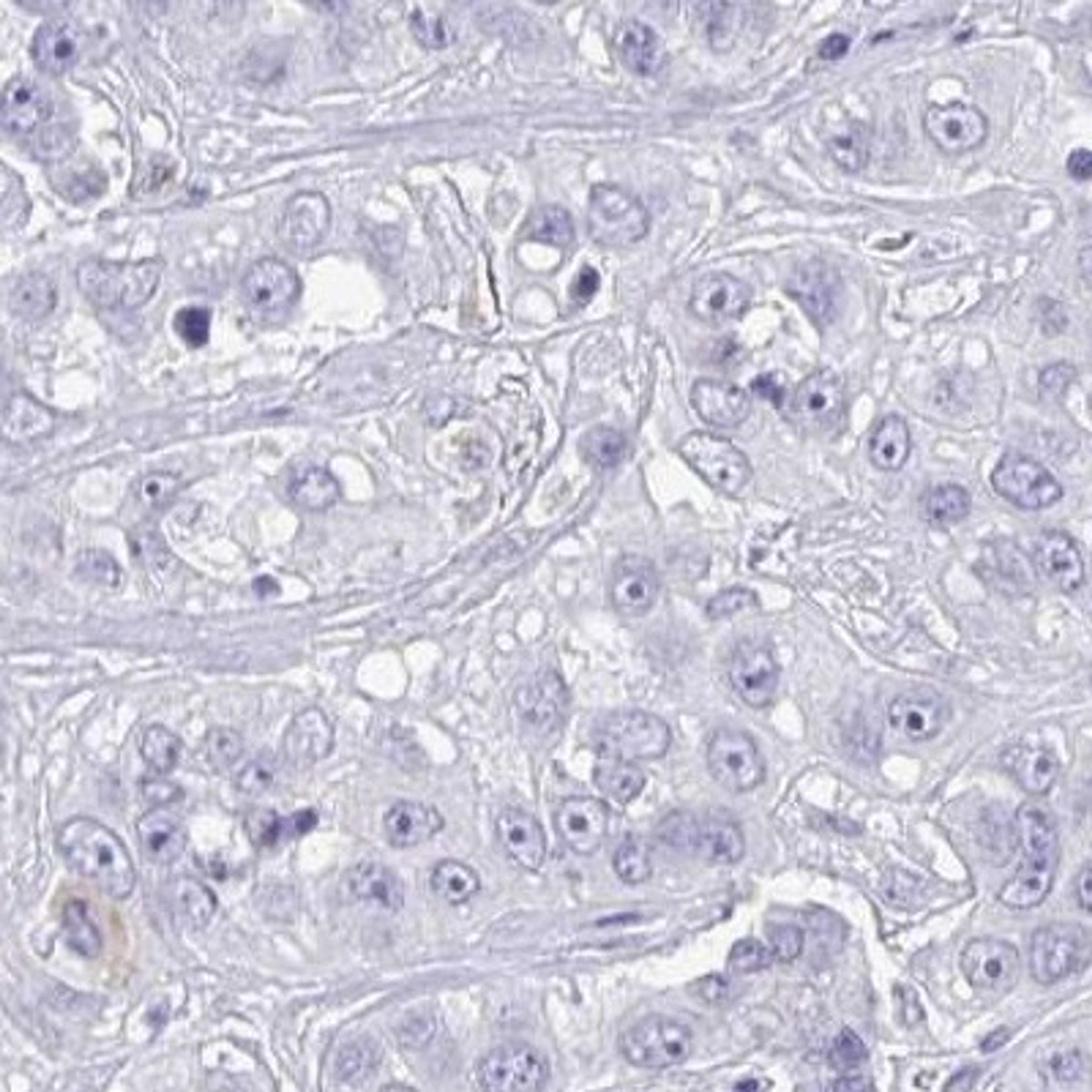 Immunohistochemistry: QDPR Antibody [NBP2-32408] - liver cancer