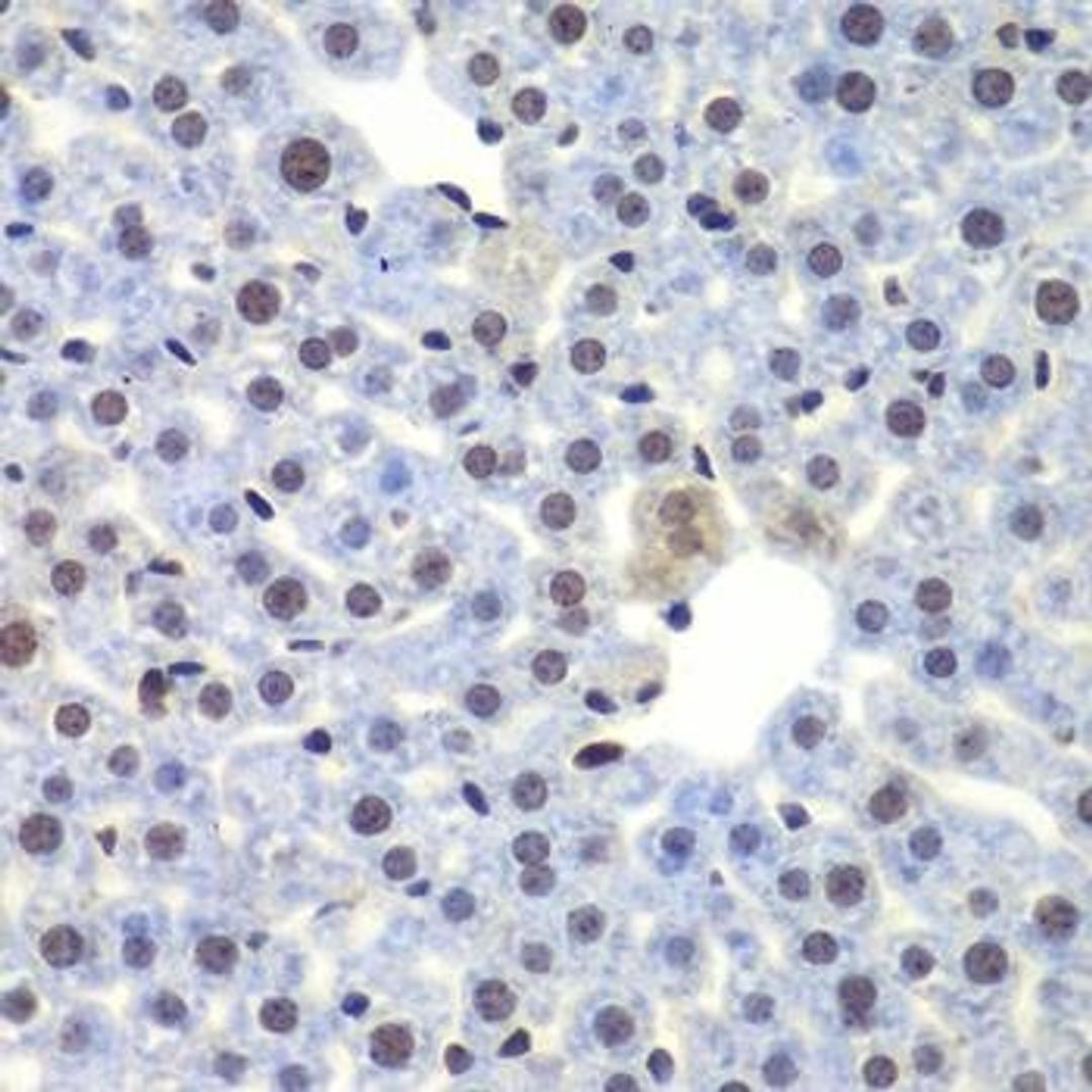 Immunohistochemical staining of human colon carcinoma tissue using CEBPG antibody (dilution of 1:100)