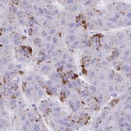 Immunohistochemistry: ANKRD60 Antibody [NBP2-32554] - liver cancer