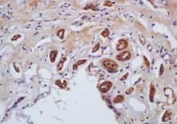 Immunohistochemical analysis of formalin-fixed paraffin embedded human gastric carcinoma tissue using MLC (phospho-Ser20) antibody (dilution at 1:200)