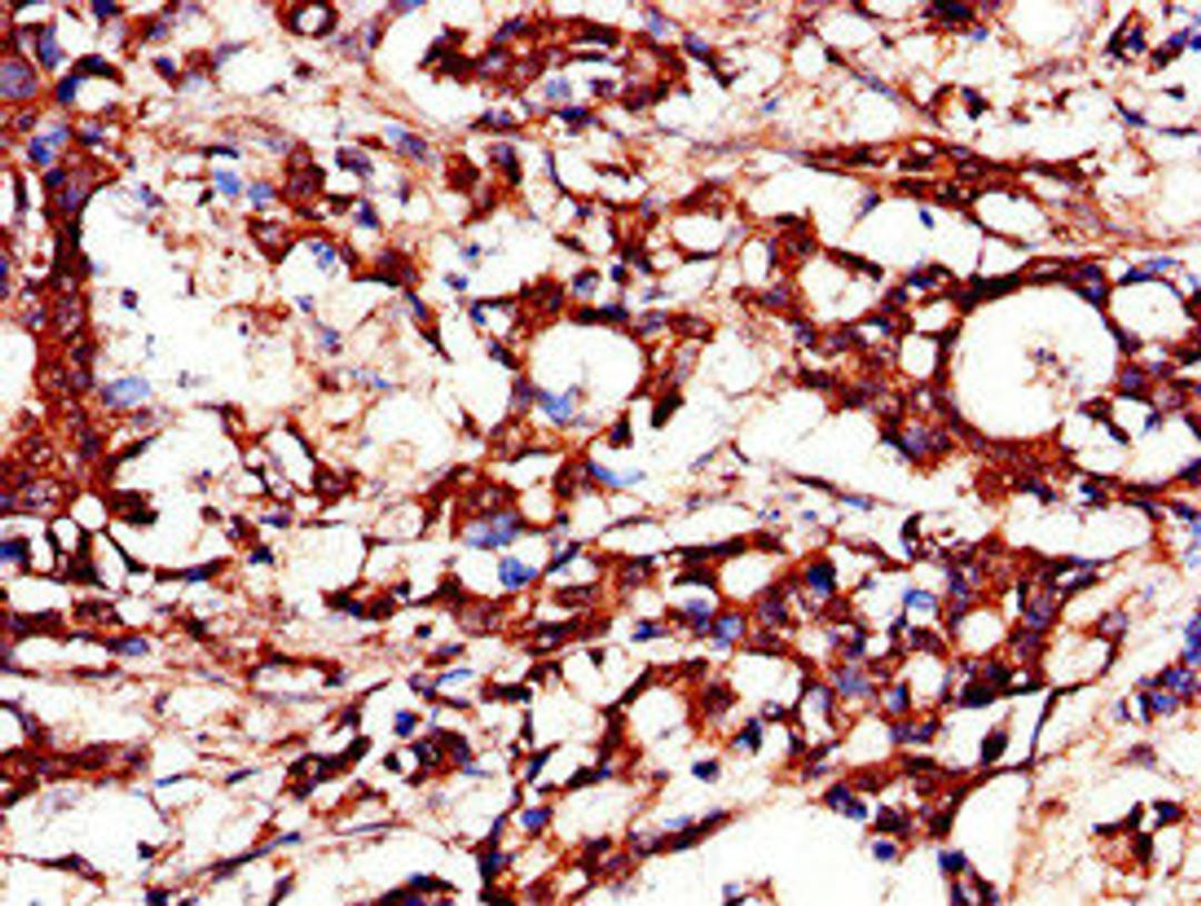 Immunohistochemistry of paraffin-embedded human gastric cancer using CSB-PA855469LA01HU at dilution of 1:100