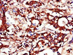 Immunohistochemistry of paraffin-embedded human gastric cancer using CSB-PA855469LA01HU at dilution of 1:100