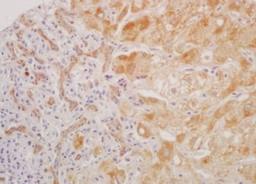 Immunohistochemical analysis of formalin-fixed paraffin embedded human liver carcinoma tissue using LATS1 (phospho-Thr1079) antibody (dilution at 1:200)