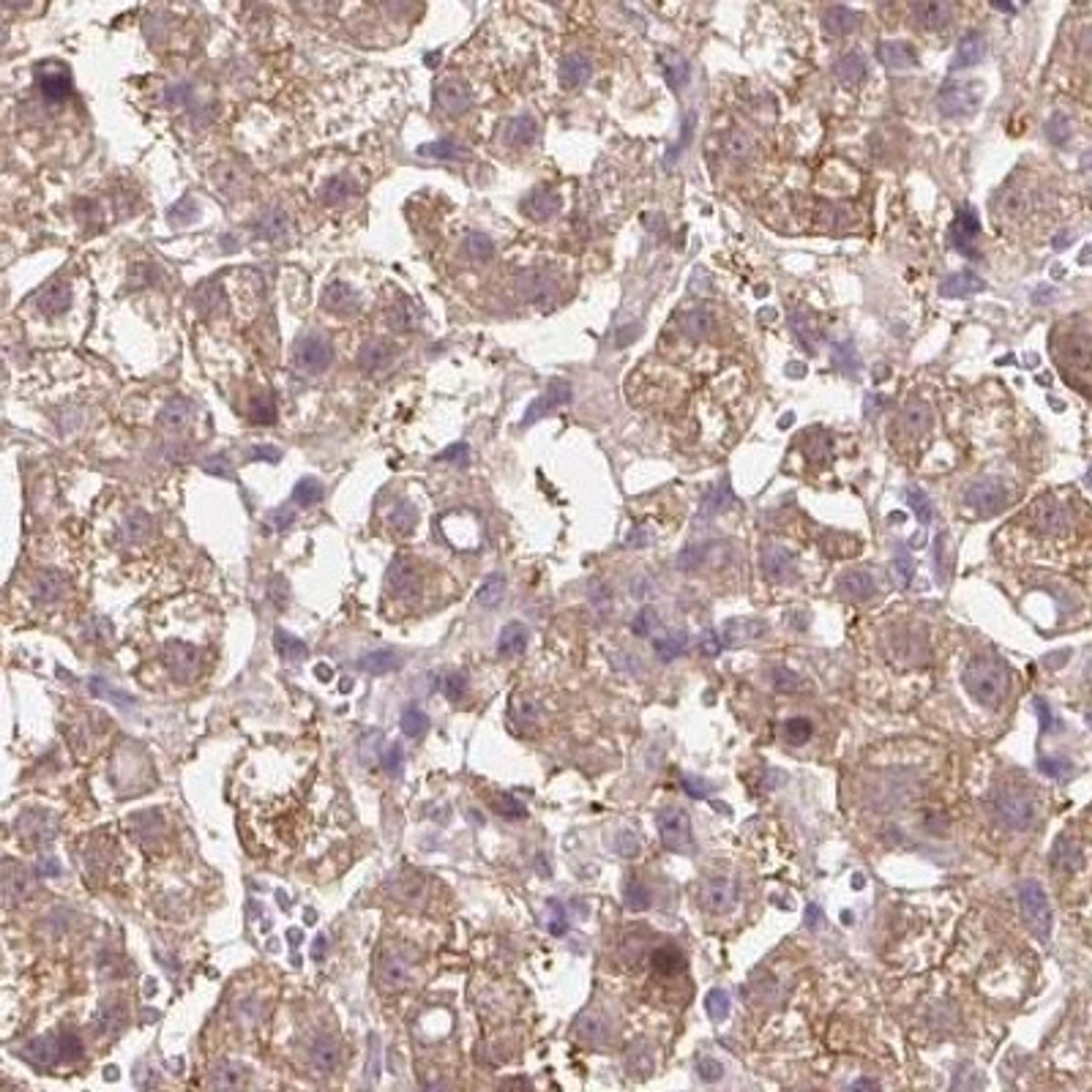 Immunohistochemistry-Paraffin: Fbl14 Antibody [NBP2-33296] - liver cancer