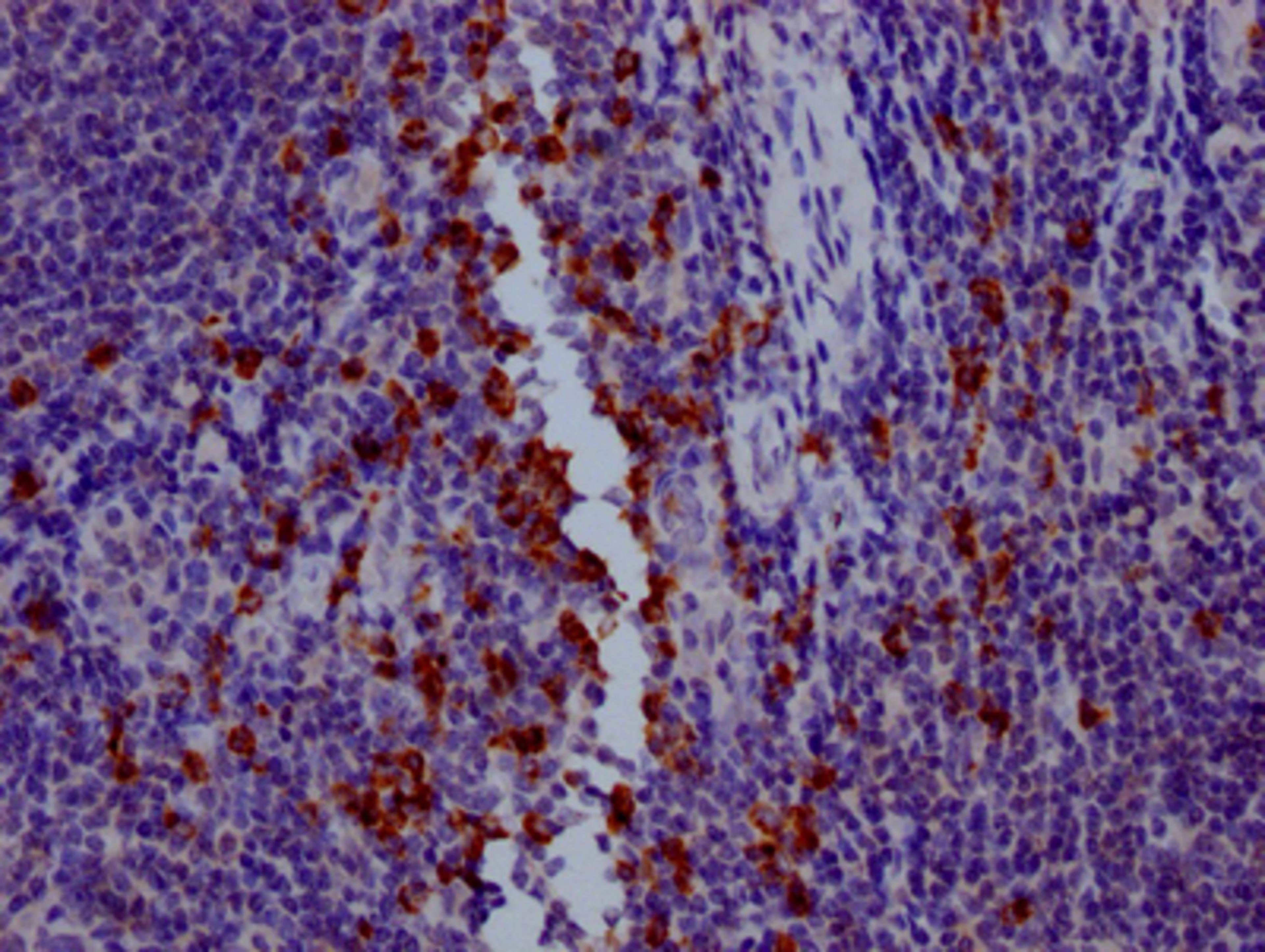 IHC image of CSB-RA794900A0HU diluted at 1:100 and staining in paraffin-embedded human tonsil tissue performed on a Leica BondTM system. After dewaxing and hydration, antigen retrieval was mediated by high pressure in a citrate buffer (pH 6.0). Section was blocked with 10% normal goat serum 30min at RT. Then primary antibody (1% BSA) was incubated at 4℃ overnight. The primary is detected by a Goat anti-rabbit IgG polymer labeled by HRP and visualized using 0.05% DAB.