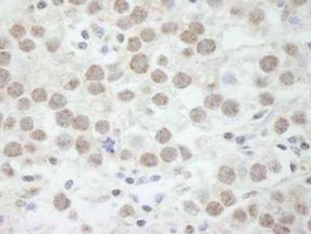 Immunohistochemistry-Paraffin: DDX17 Antibody [NB200-352] - FFPE section of human seminoma.  Affinity purified rabbit anti-DDX17 used at a dilution of 1:500.  Detection: DAB staining using Immunohistochemistry Accessory Kit