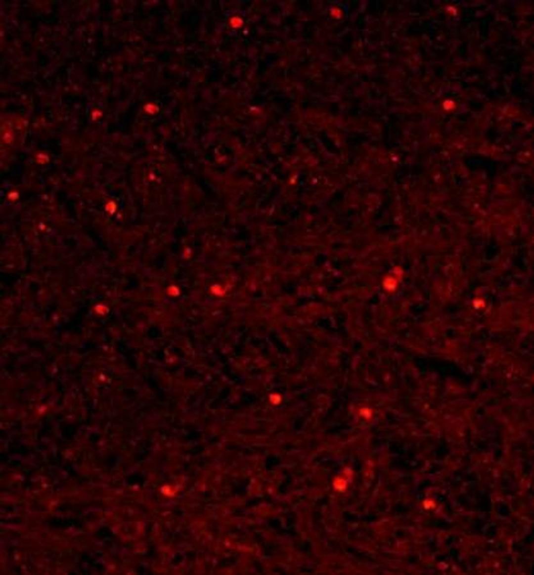 Immunohistochemical analysis of formalin-fixed paraffin embedded human gastric carcinoma tissue using NFkB p65 antibody