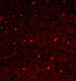 Immunohistochemical analysis of formalin-fixed paraffin embedded human gastric carcinoma tissue using NFkB p65 antibody