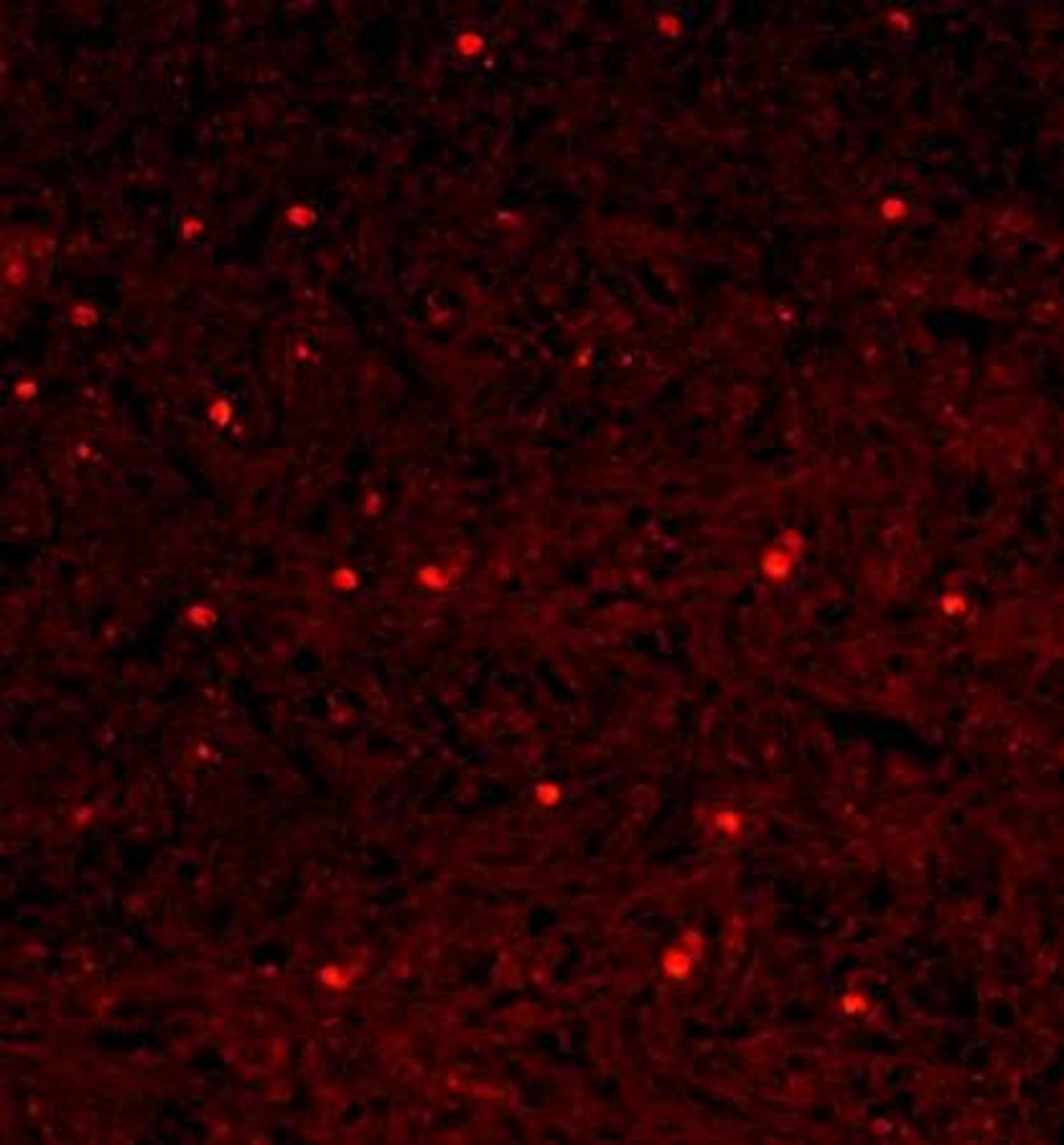 Immunohistochemical analysis of formalin-fixed paraffin embedded human gastric carcinoma tissue using NFkB p65 antibody