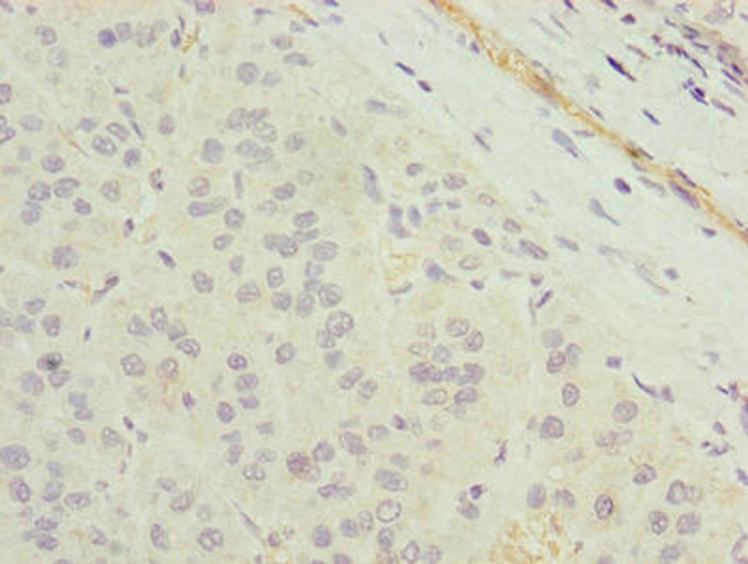 Immunohistochemistry of paraffin-embedded human liver cancer using CSB-PA023759LA01HU at dilution of 1:100
