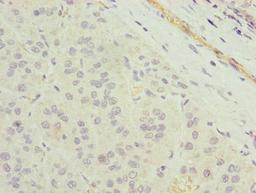 Immunohistochemistry of paraffin-embedded human liver cancer using CSB-PA023759LA01HU at dilution of 1:100