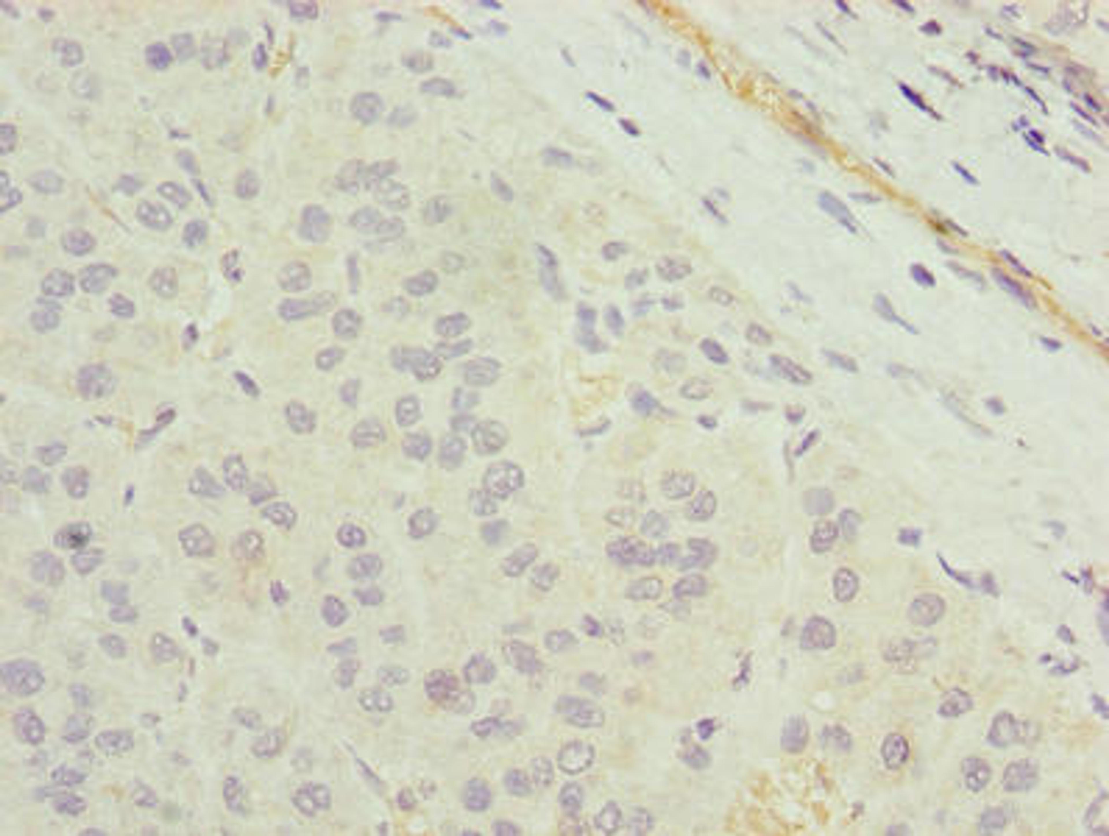 Immunohistochemistry of paraffin-embedded human liver cancer using CSB-PA023759LA01HU at dilution of 1:100