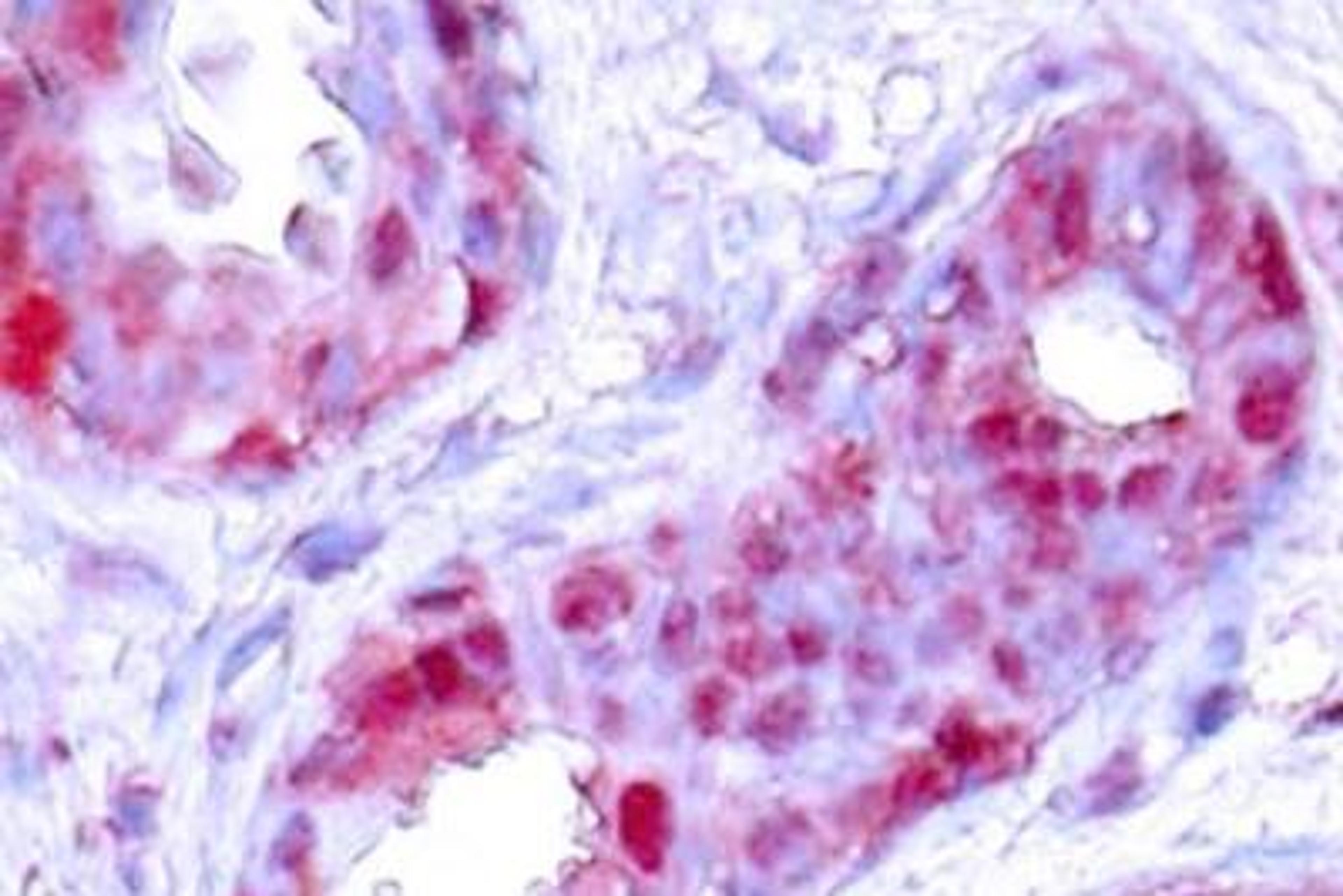 Immunohistochemistry-Paraffin: c-jun Antibody [NB100-92503] - Paraffin-embedded human breast carcinoma tissue.